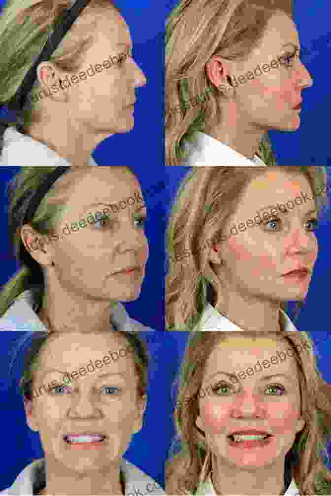 Before And After Facelift Cosmetic Dermatologic Surgery Donna M Orange