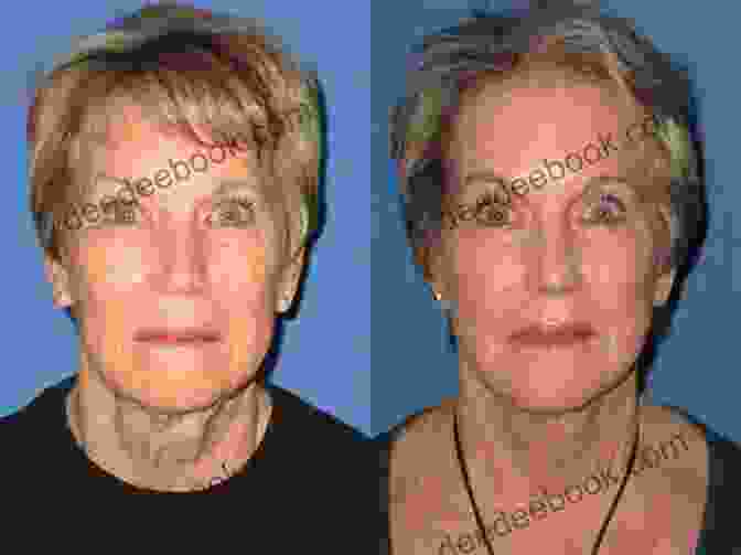 Before And After Facelift Cosmetic Dermatologic Surgery Donna M Orange