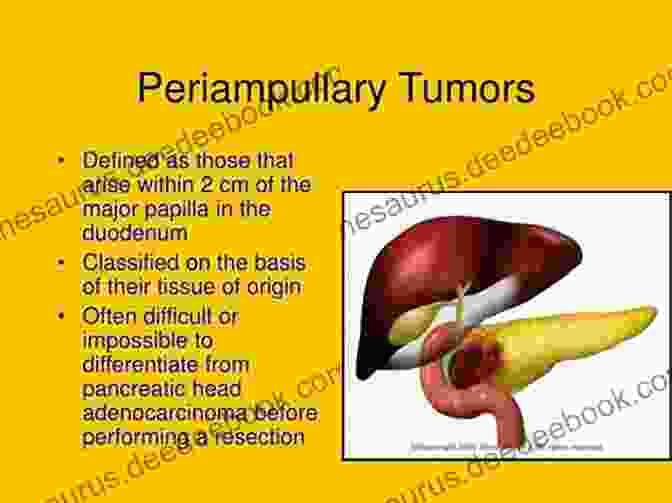 Periampullary Adenocarcinoma Pancreatic Cancer And Periampullary Neoplasms An Issue Of Surgical Clinics Of North America (The Clinics: Surgery 96)