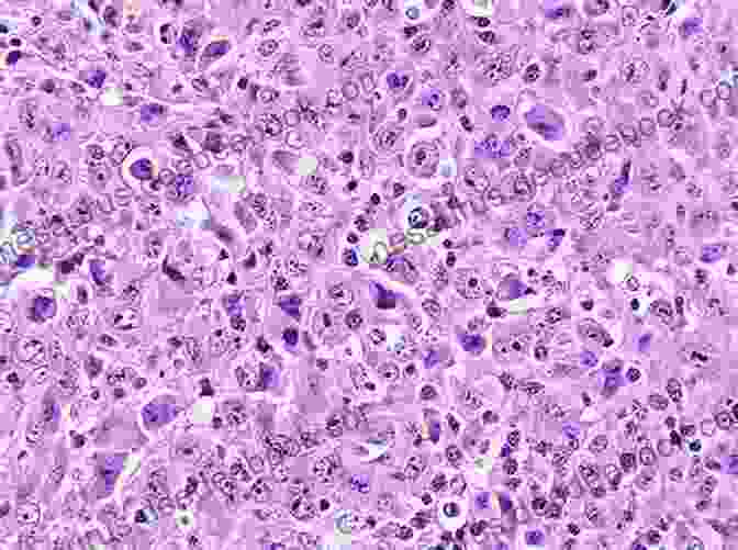 Photomicrograph Of A Diffuse Large B Cell Lymphoma, Showing Large Lymphoid Cells With Irregular Nuclei And Prominent Nucleoli. Surgical Pathology Of The Head And Neck