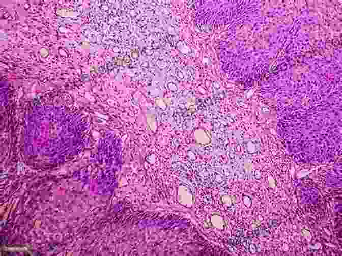 Photomicrograph Of An Inverted Papilloma, A Common Type Of Benign Sinonasal Tumor. Surgical Pathology Of The Head And Neck