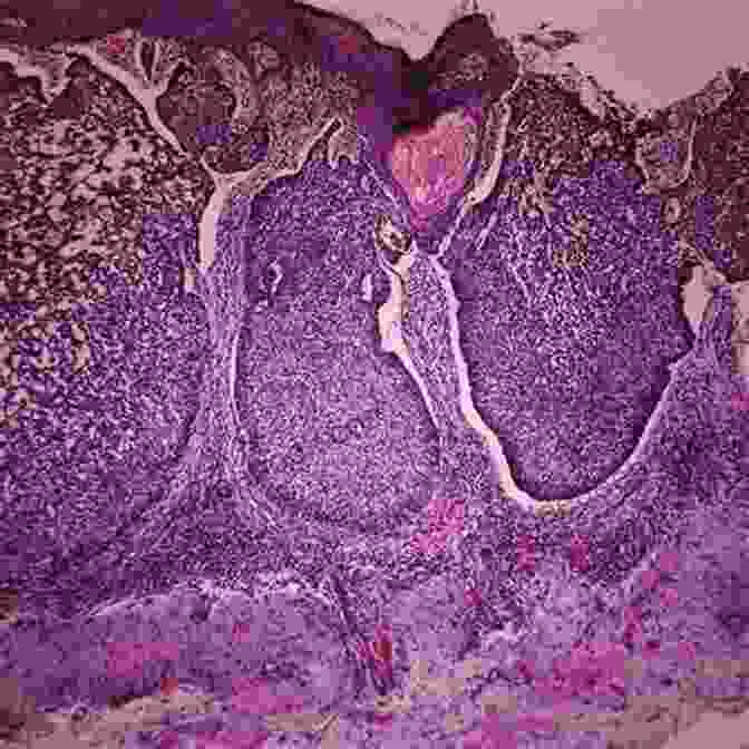 Photomicrograph Of Melanoma, Showing Atypical Melanocytes With Irregular Nuclei And Abundant Melanin Pigment. Surgical Pathology Of The Head And Neck